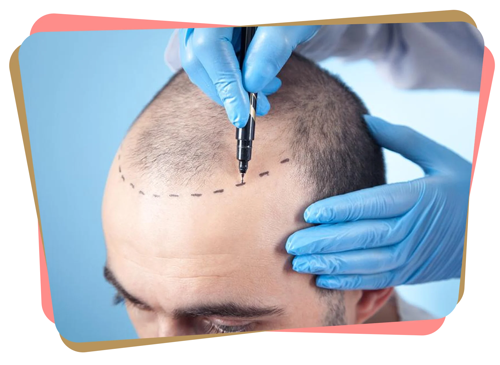 Close-up of male scalp with dotted hairline markings as a doctor wearing gloves outlines the area for hair transplant surgery.
