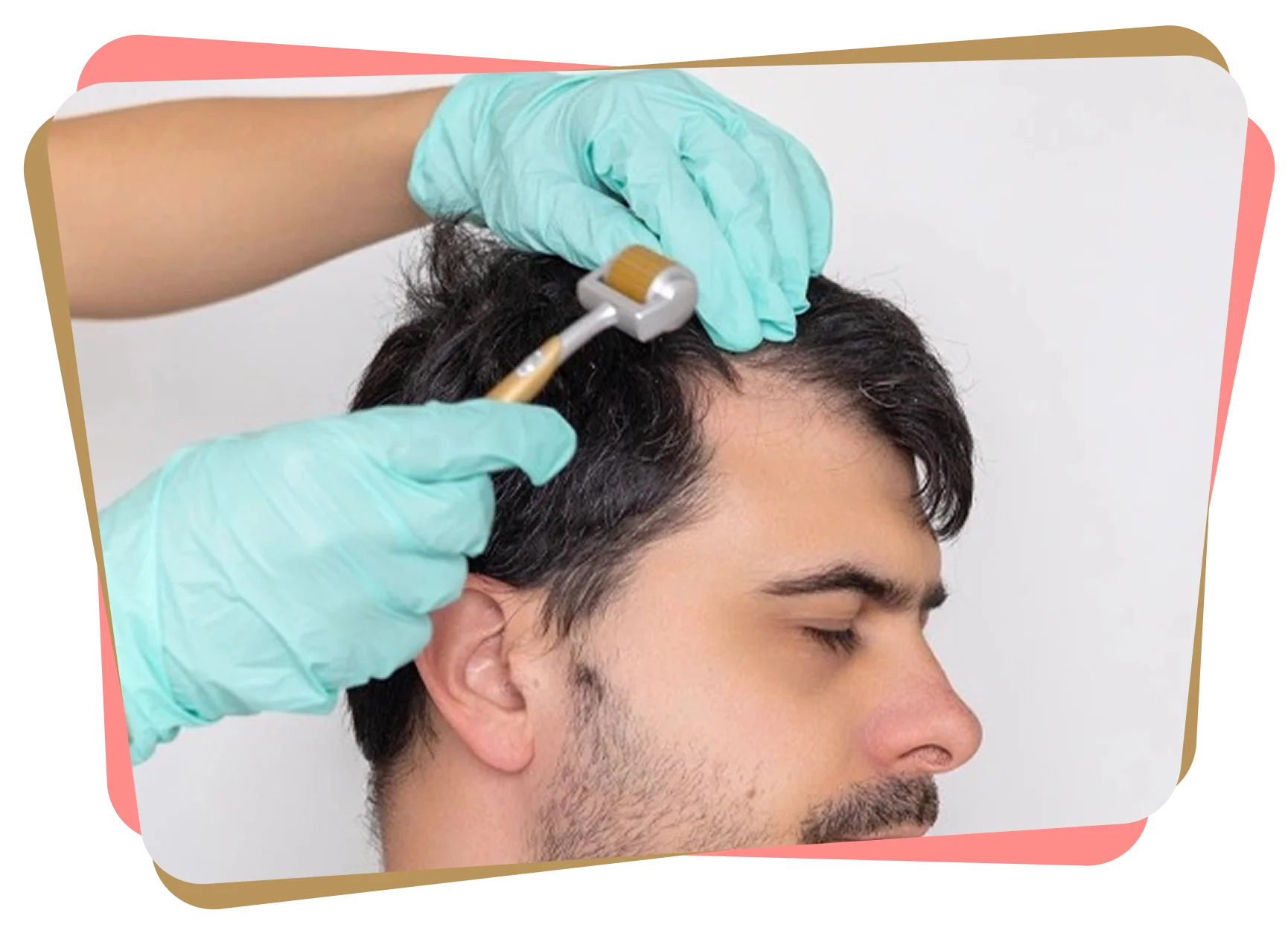 Doctor performing microneedling treatment on a man’s scalp to stimulate hair growth.