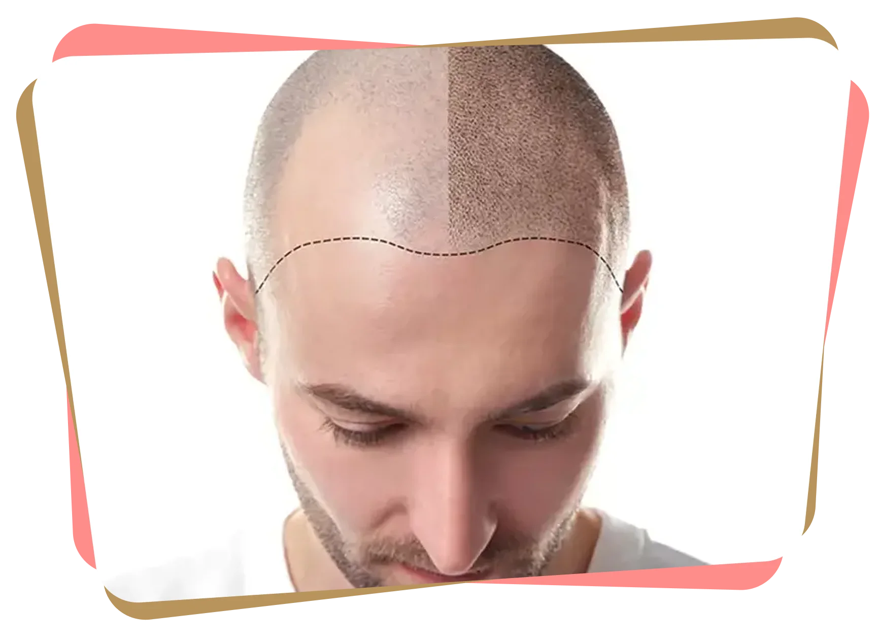 Top view of a man with hair loss showing a marked hairline and partial hair transplant result on one side of the scalp.