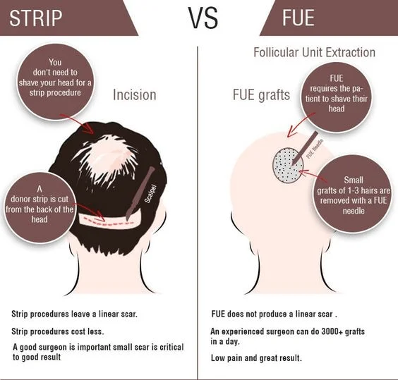 Infographic comparing Strip hair transplant and FUE technique, explaining incision method, scarring, graft extraction, and recovery differences.