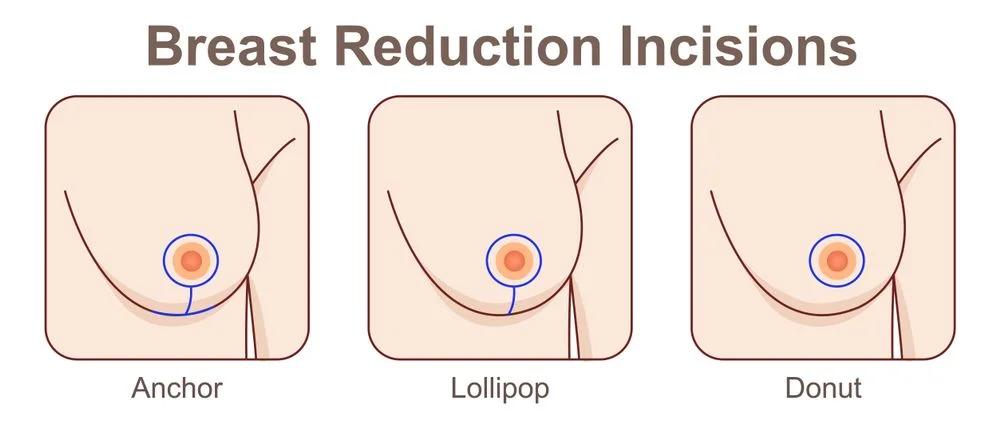 Illustration of breast reduction incision patterns showing anchor, lollipop, and donut techniques.