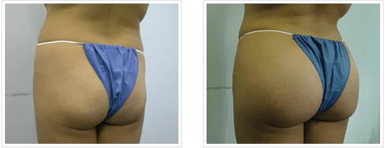 Before and after tummy tuck results, showing excess abdominal skin before surgery and a flatter abdomen with surgical scar after procedure.