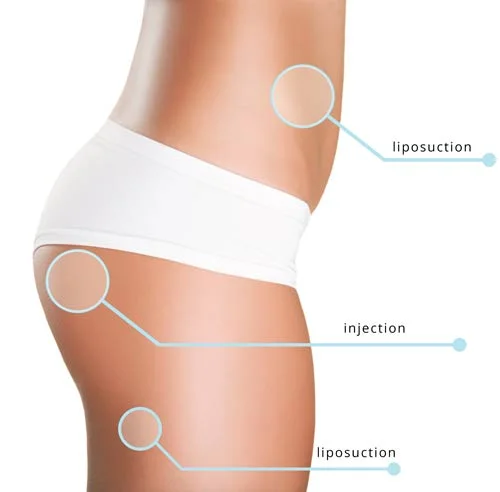 Side view illustration of a female lower body highlighting liposuction and injection treatment areas on the waist, hips, and thighs.